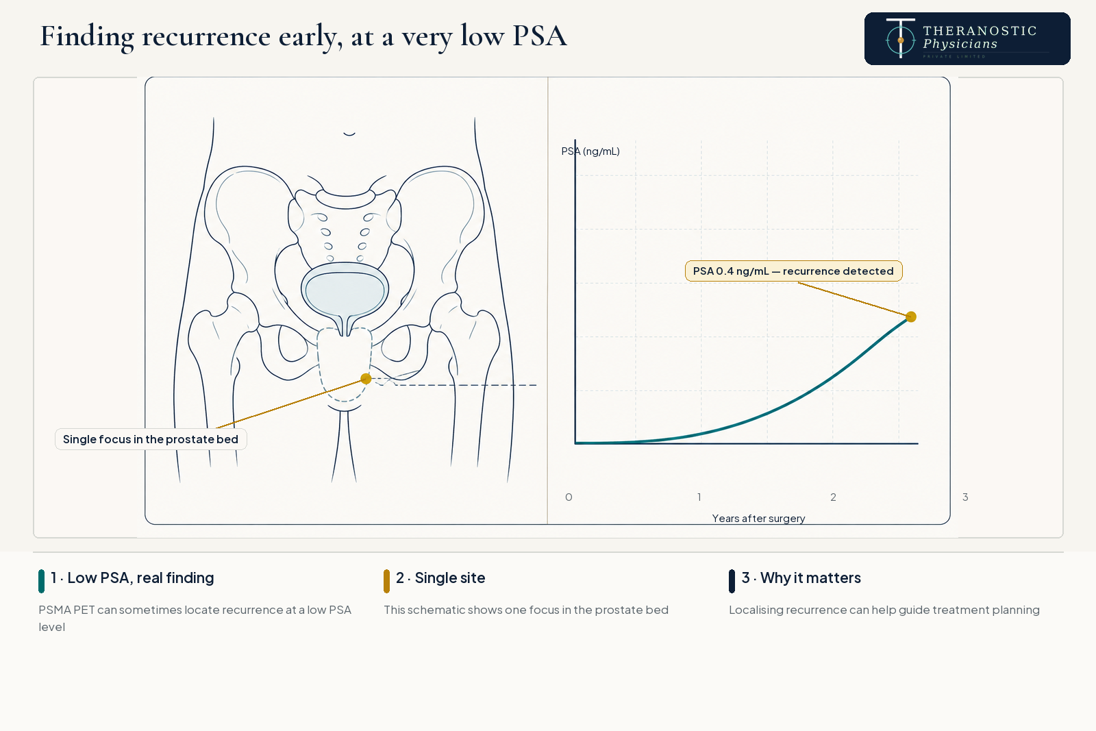 Schematic pelvis and PSA chart showing one focus in the prostate bed detected at a PSA level of 0.4 ng/mL after prostate surgery.