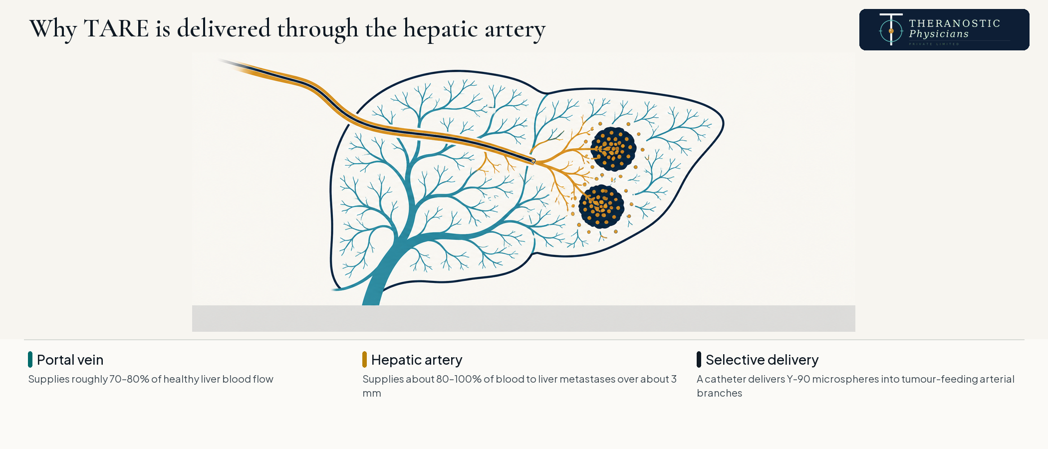 Diagram of the liver's dual blood supply showing Y-90 microspheres delivered by catheter through the hepatic artery into tumour nodules.